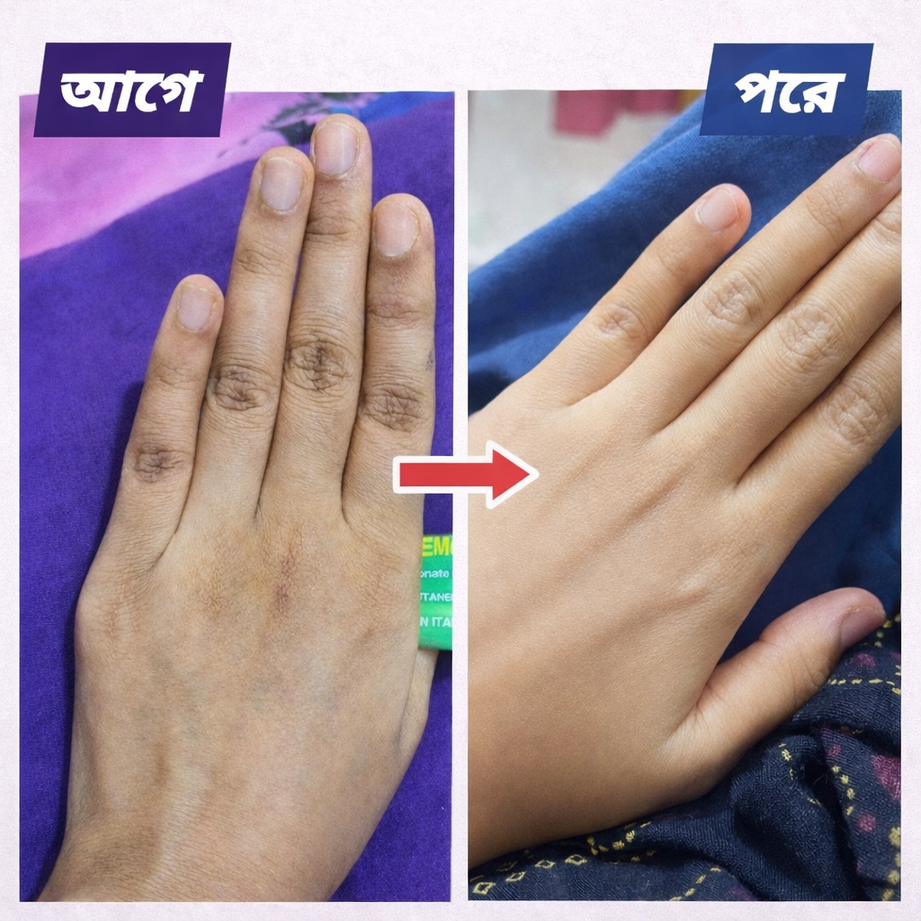 Original Lemonvate Cream 30g by Esapharma – Dark Spot Remover Cream